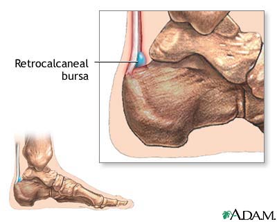 Retrocalcaneal Bursa(photo A.D.A.M Inc)