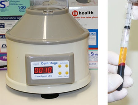 Preparing blood for PRP Treatment